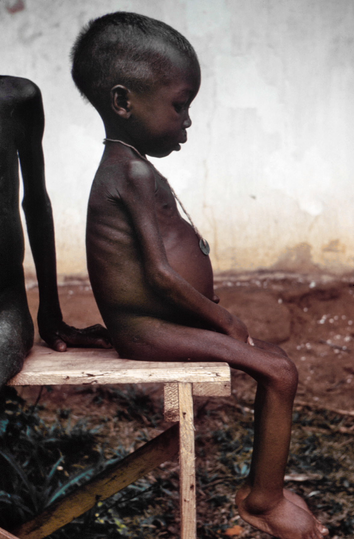 A malnourished child showing symptoms of severe acute malnutrition
